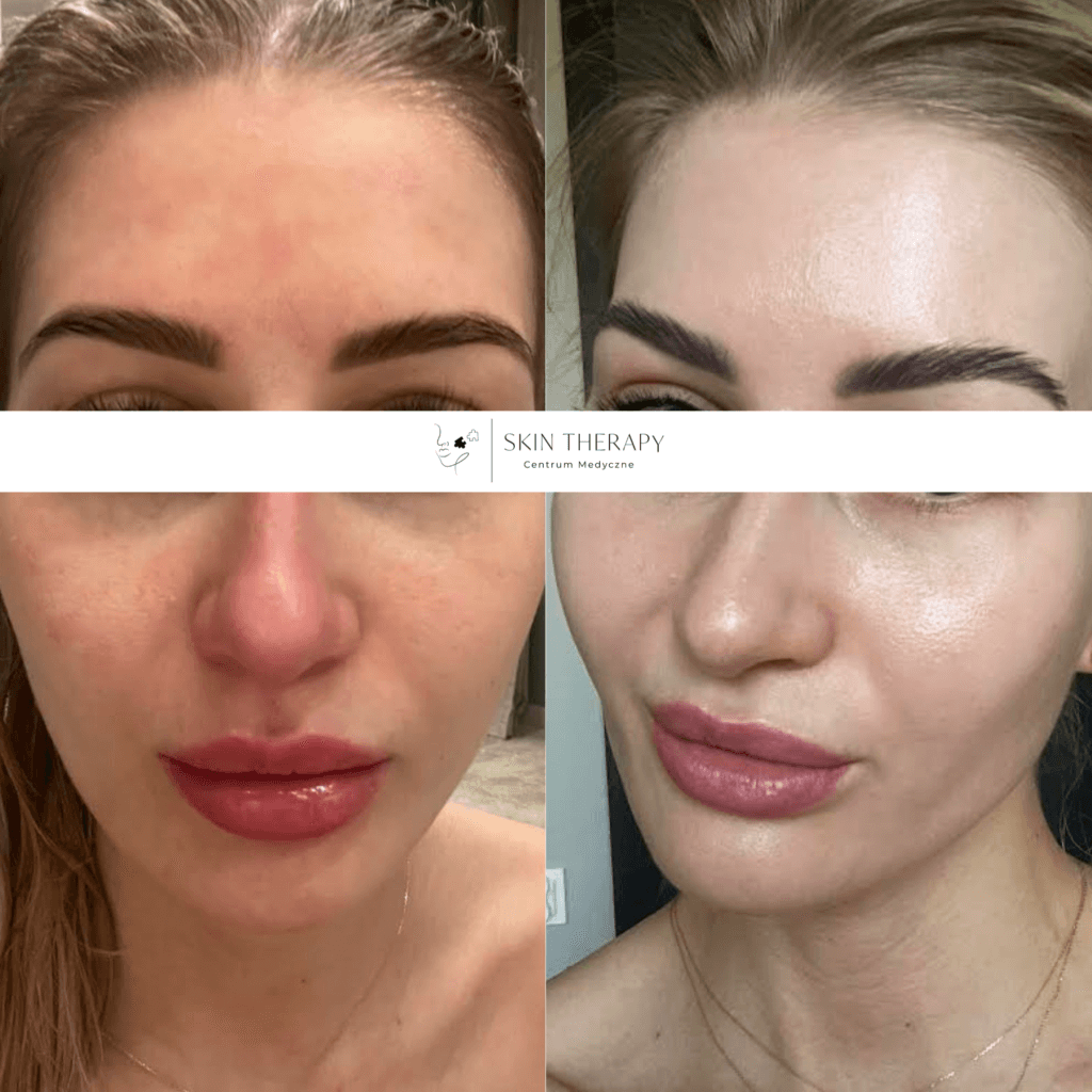 terapie skóry – 33