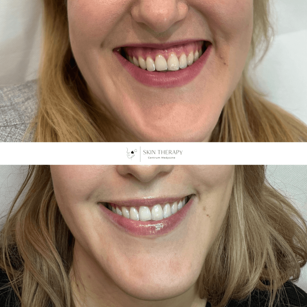 toksyna botulinowa – 5