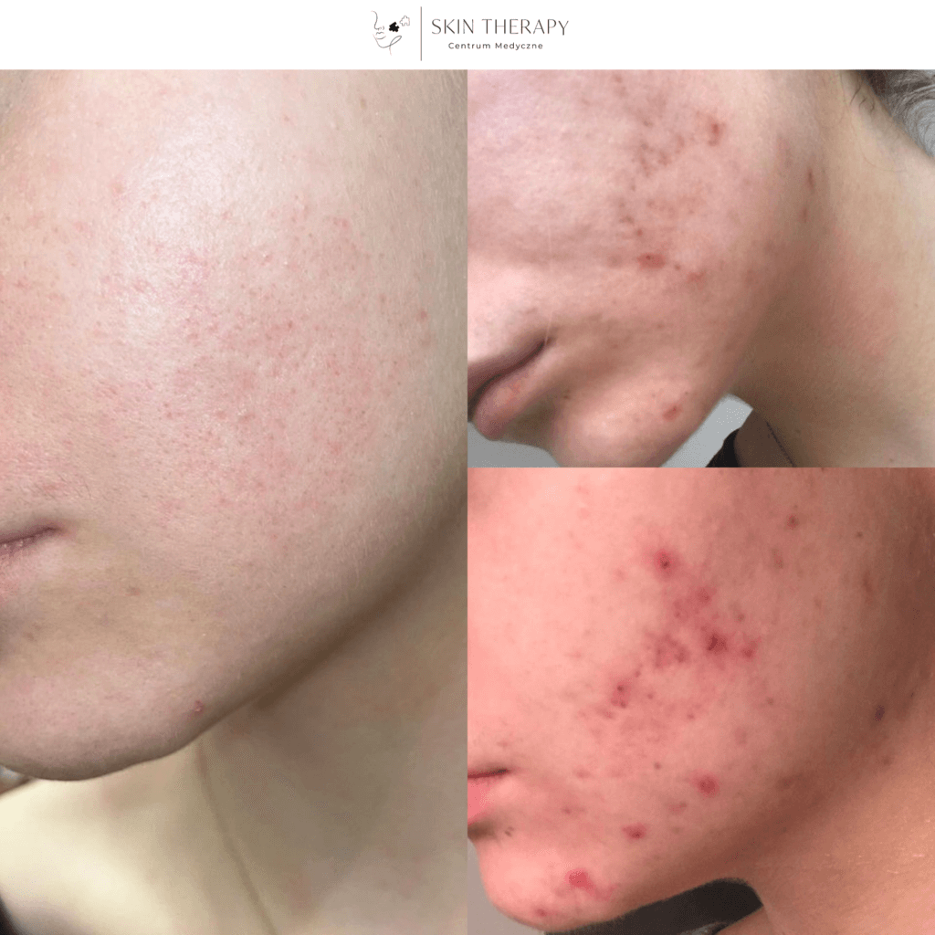 terapie skóry – 32