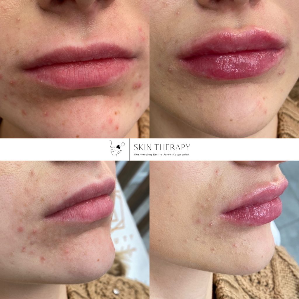 powiększanie ust – 4