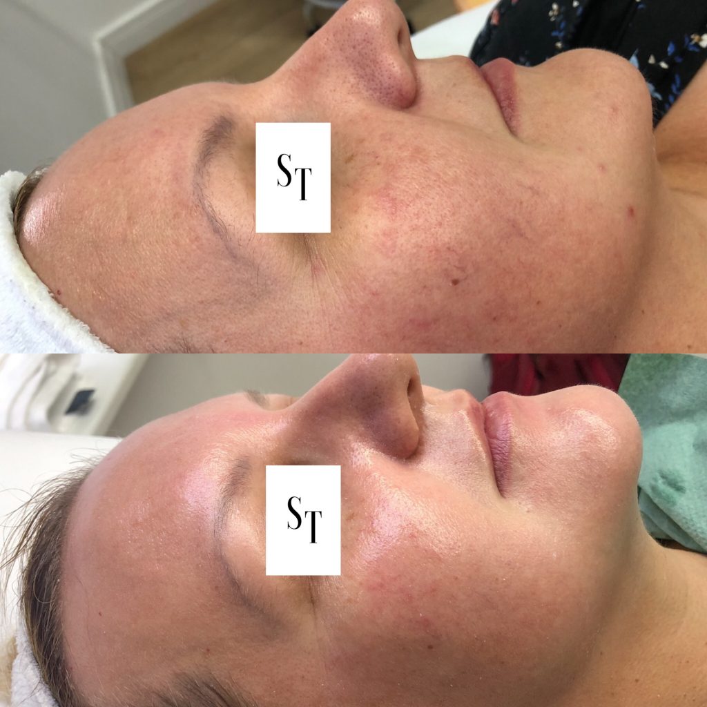 terapie skóry – 60