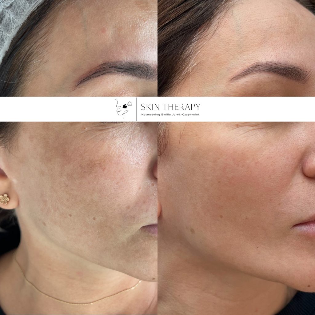 terapie skóry – 59