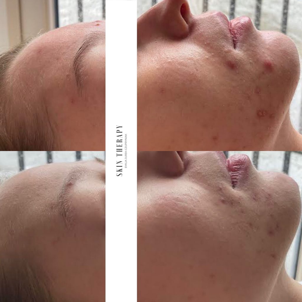 terapie skóry – 58