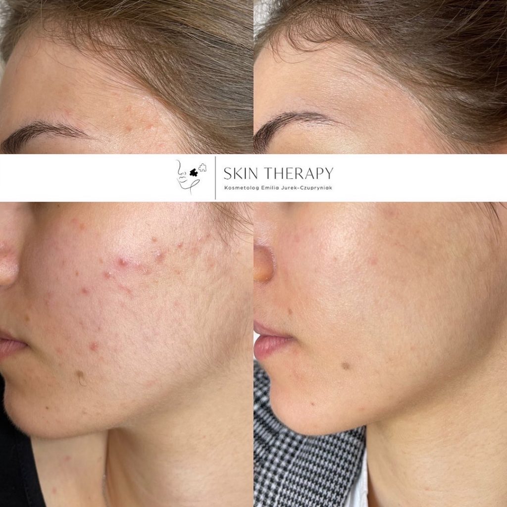 terapie skóry – 57