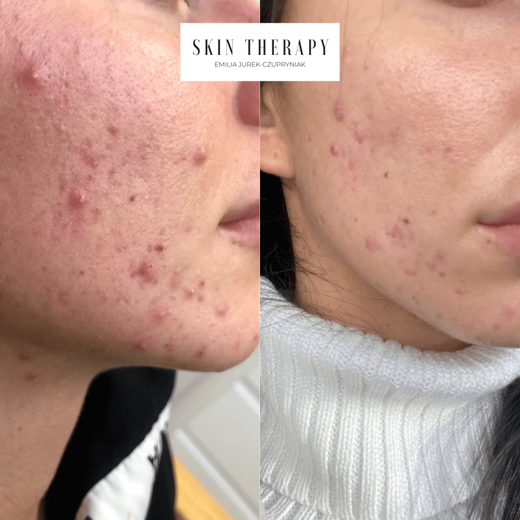 terapie skóry – 28