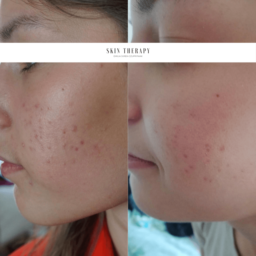 terapie skóry – 27