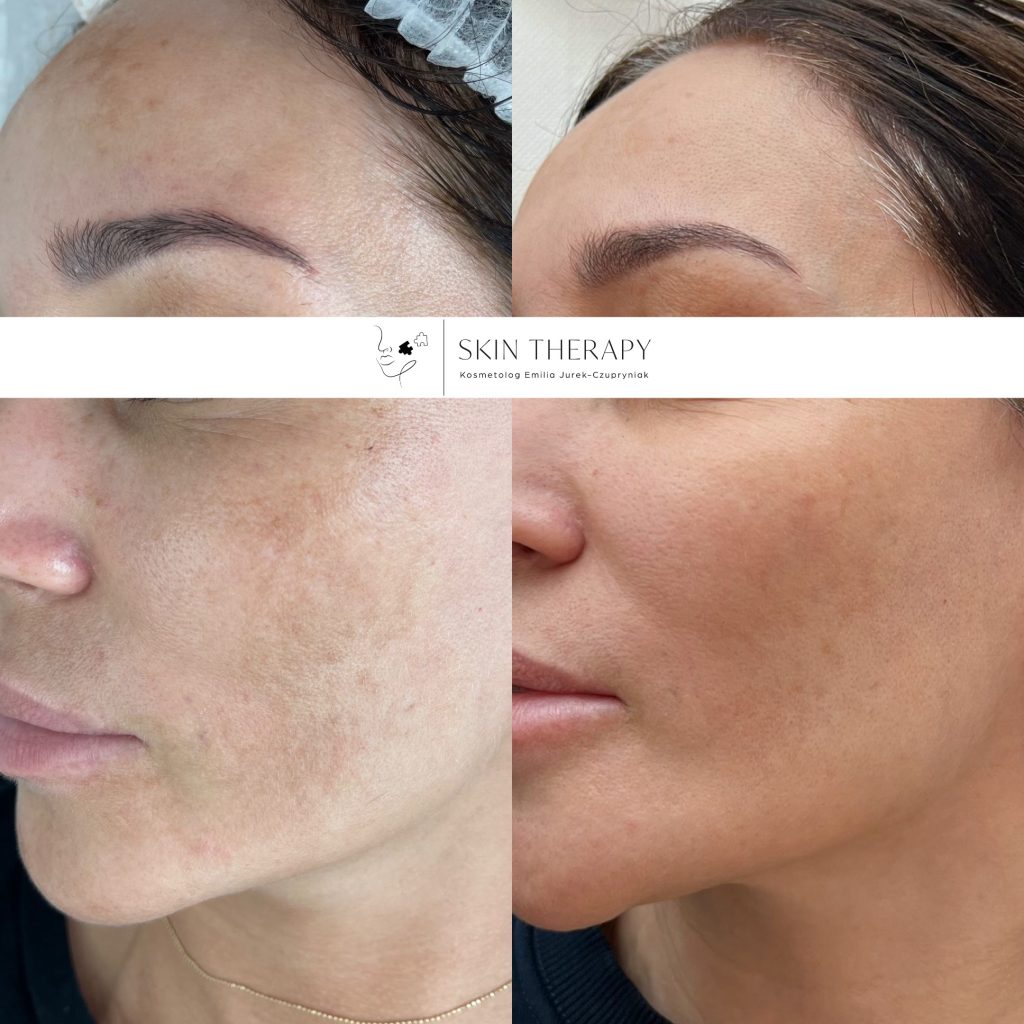 terapie skóry – 55