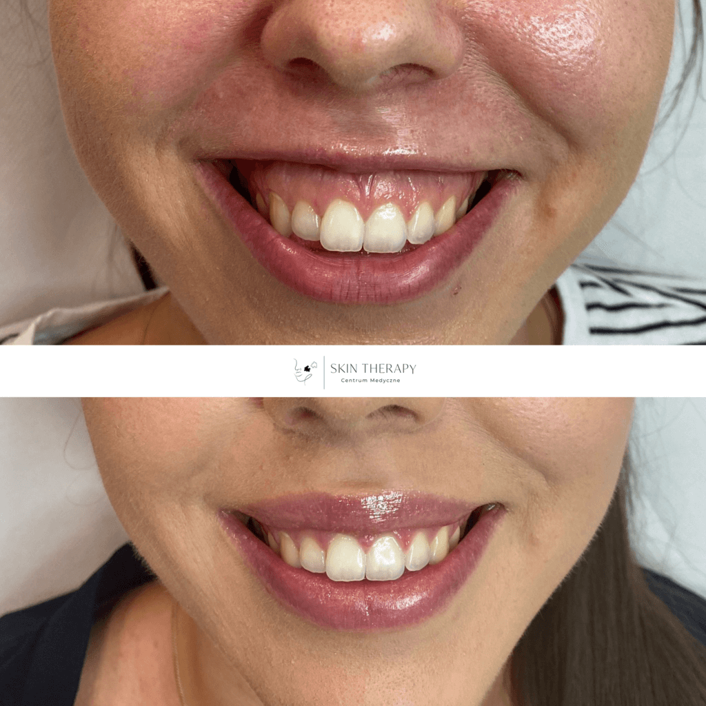 toksyna botulinowa – 2