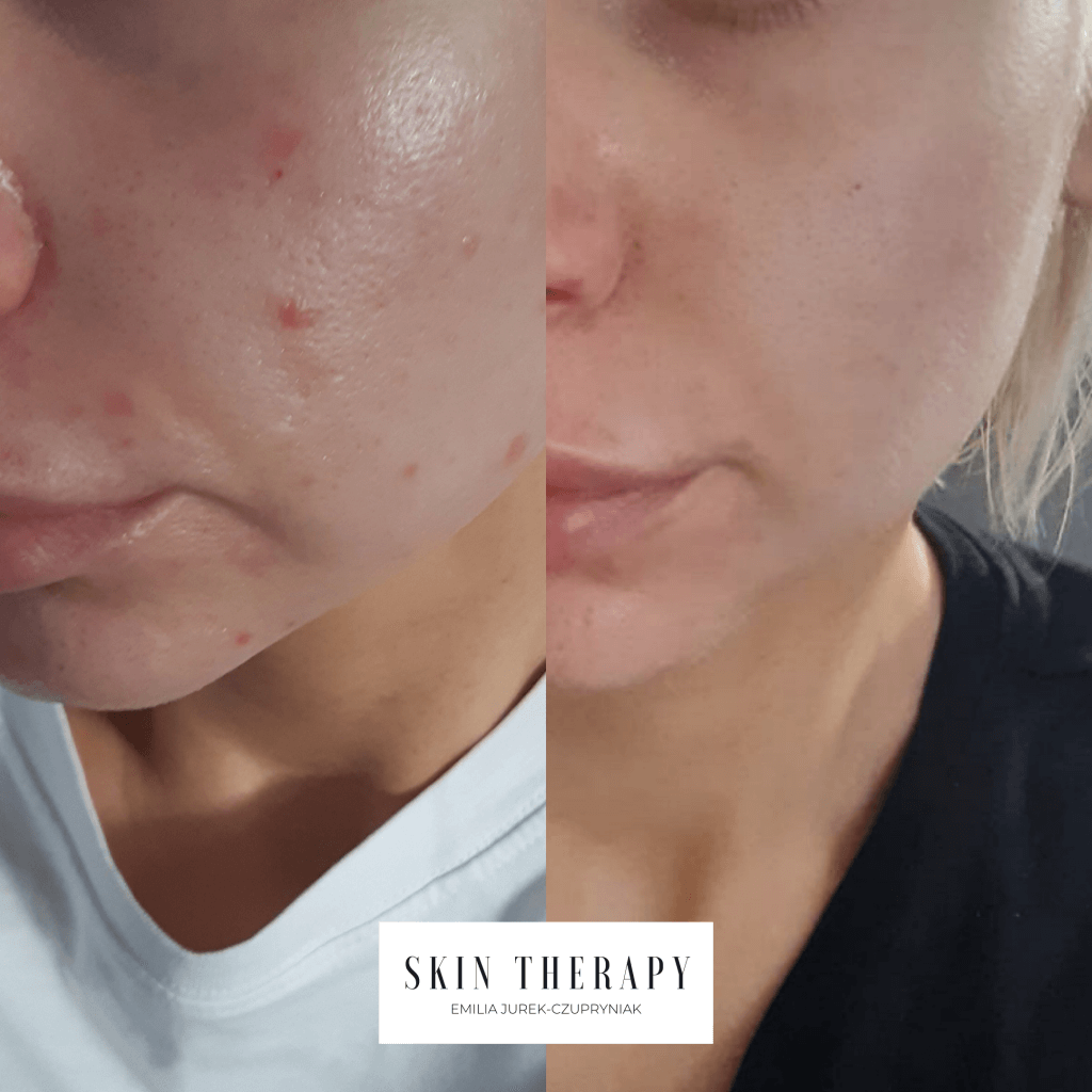 terapie skóry – 26