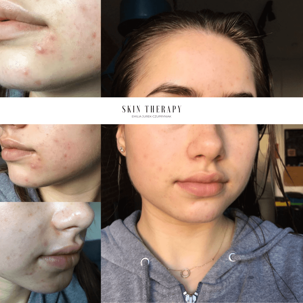 terapie skóry – 25