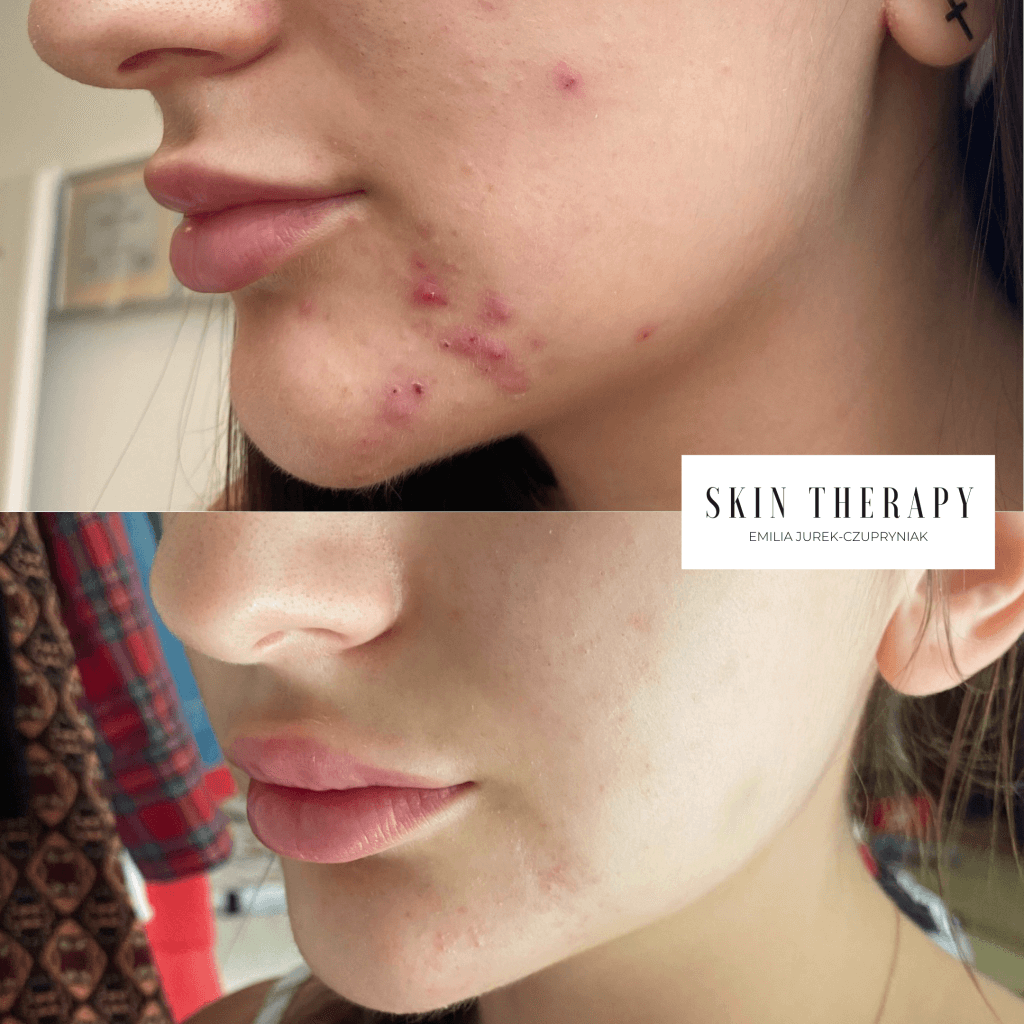 terapie skóry – 8