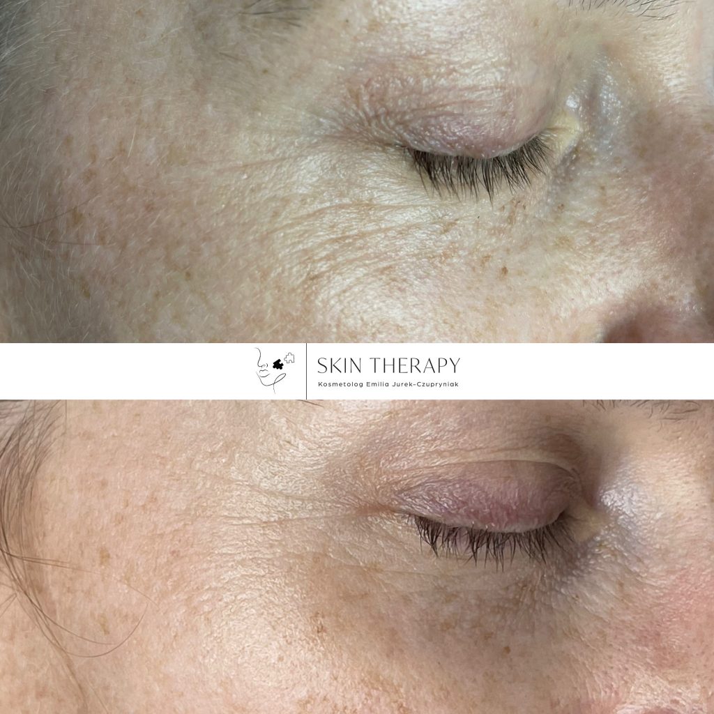terapie skóry – 54