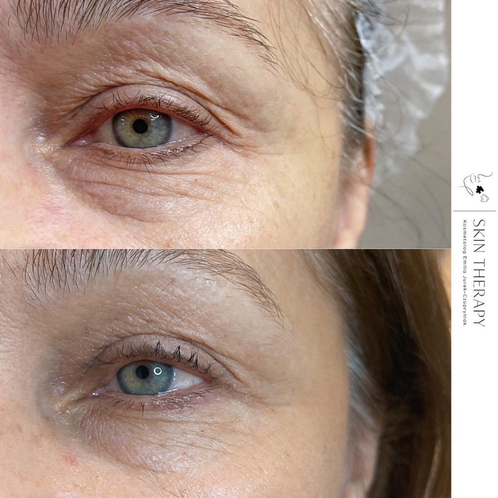 terapie skóry – 53