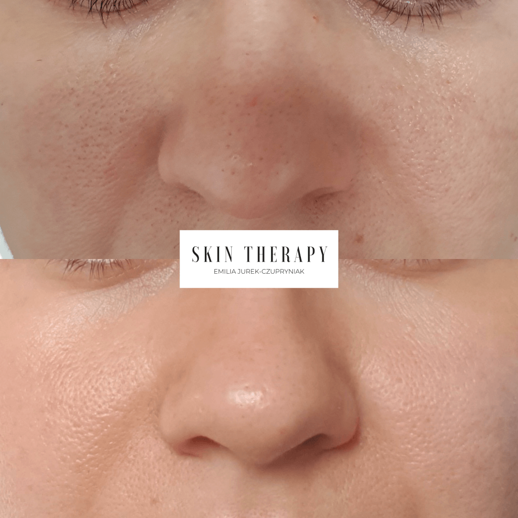 terapie skóry – 24