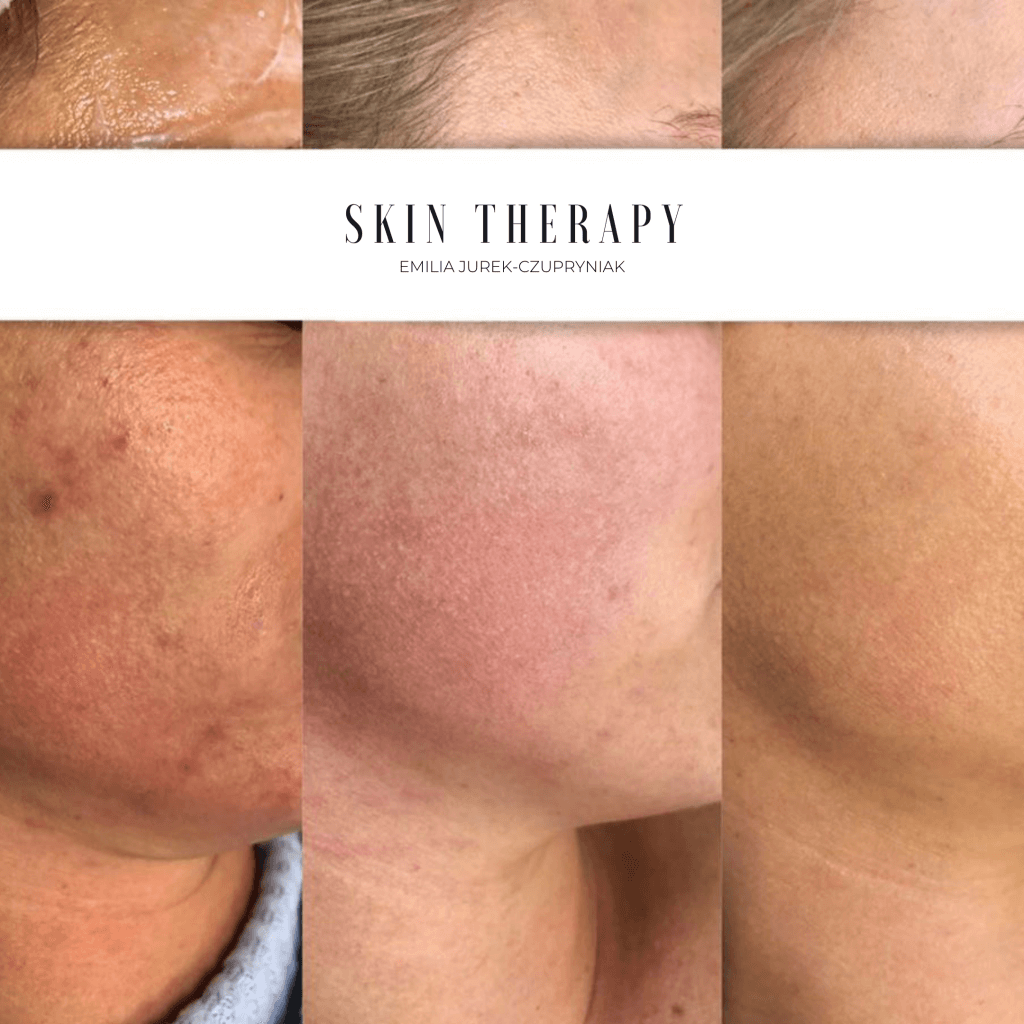 terapie skóry – 23