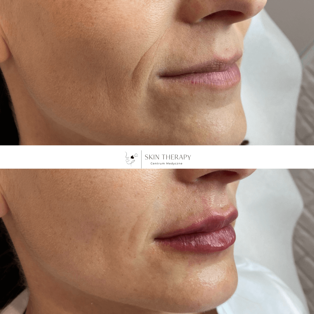 powiększanie ust – 14