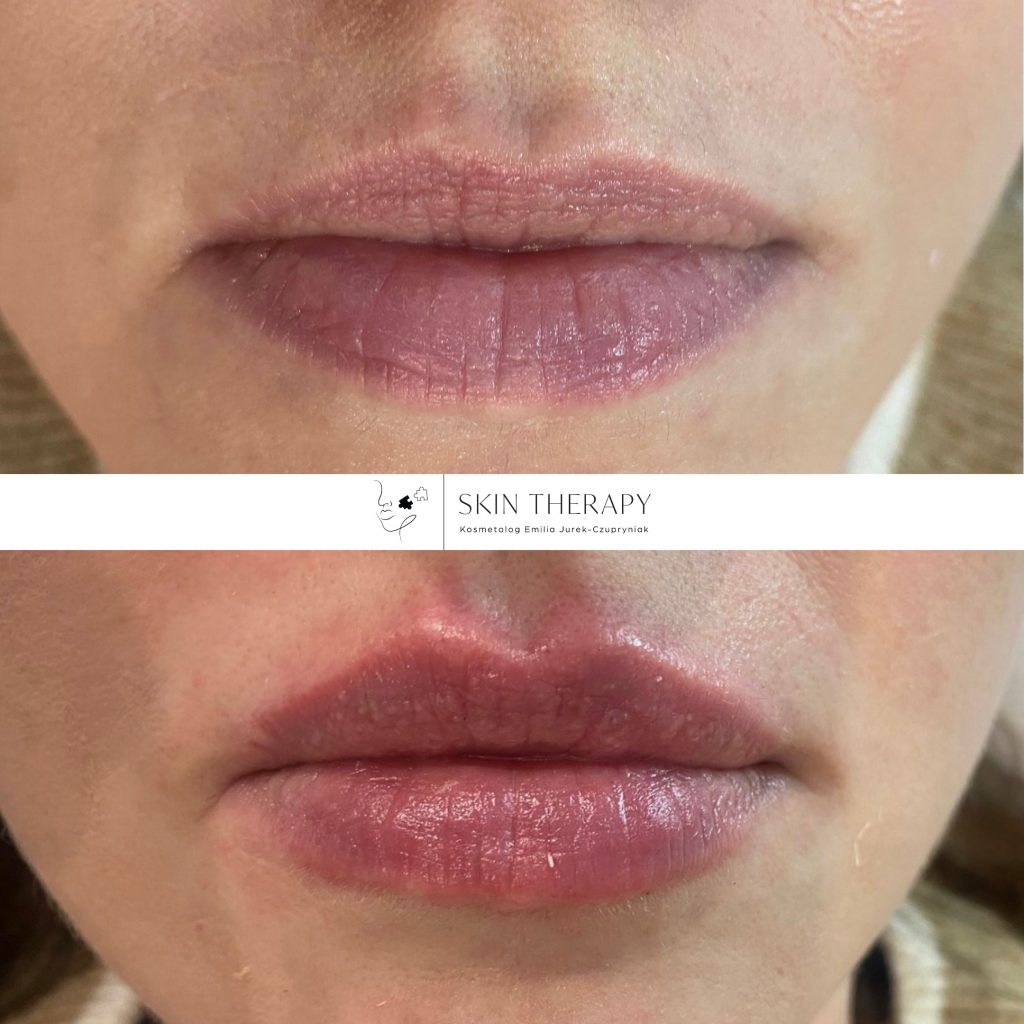 powiększanie ust – 11