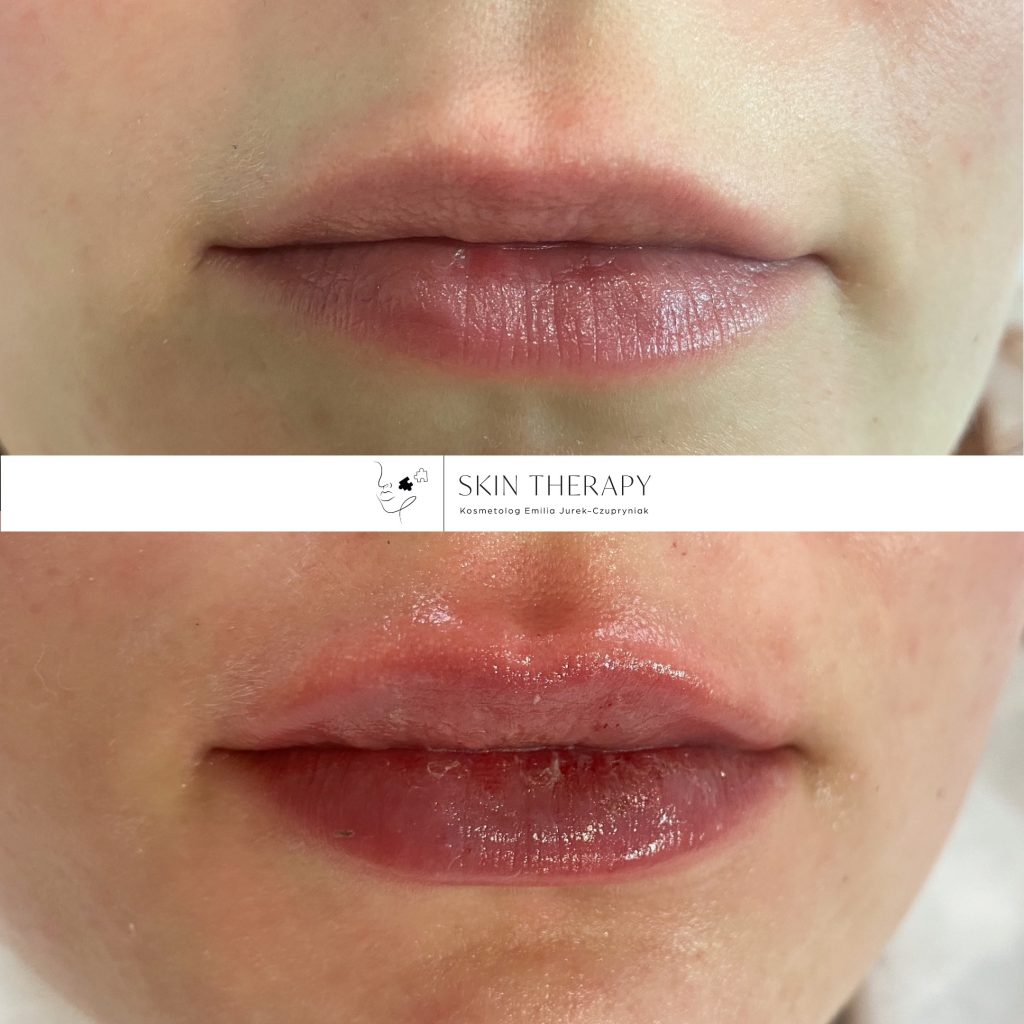 powiększanie ust – 5