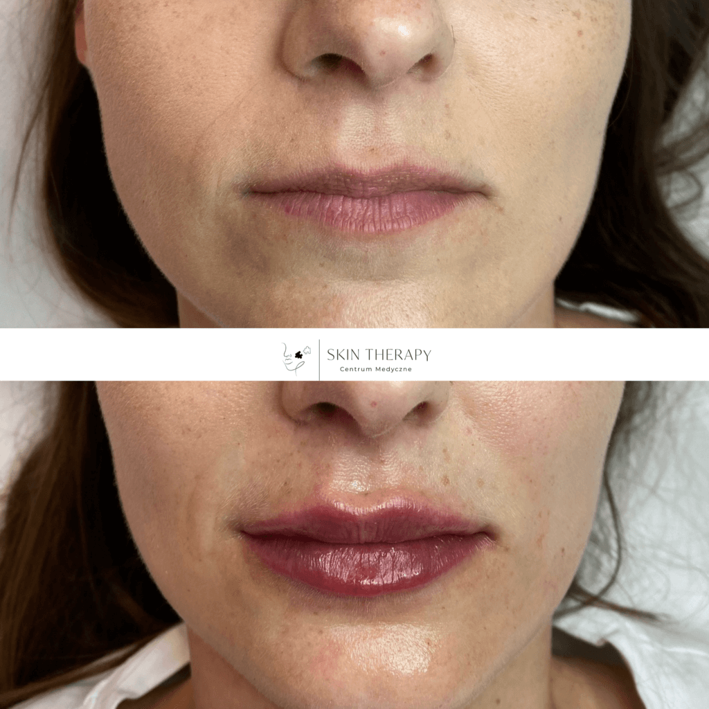 powiększanie ust – 1