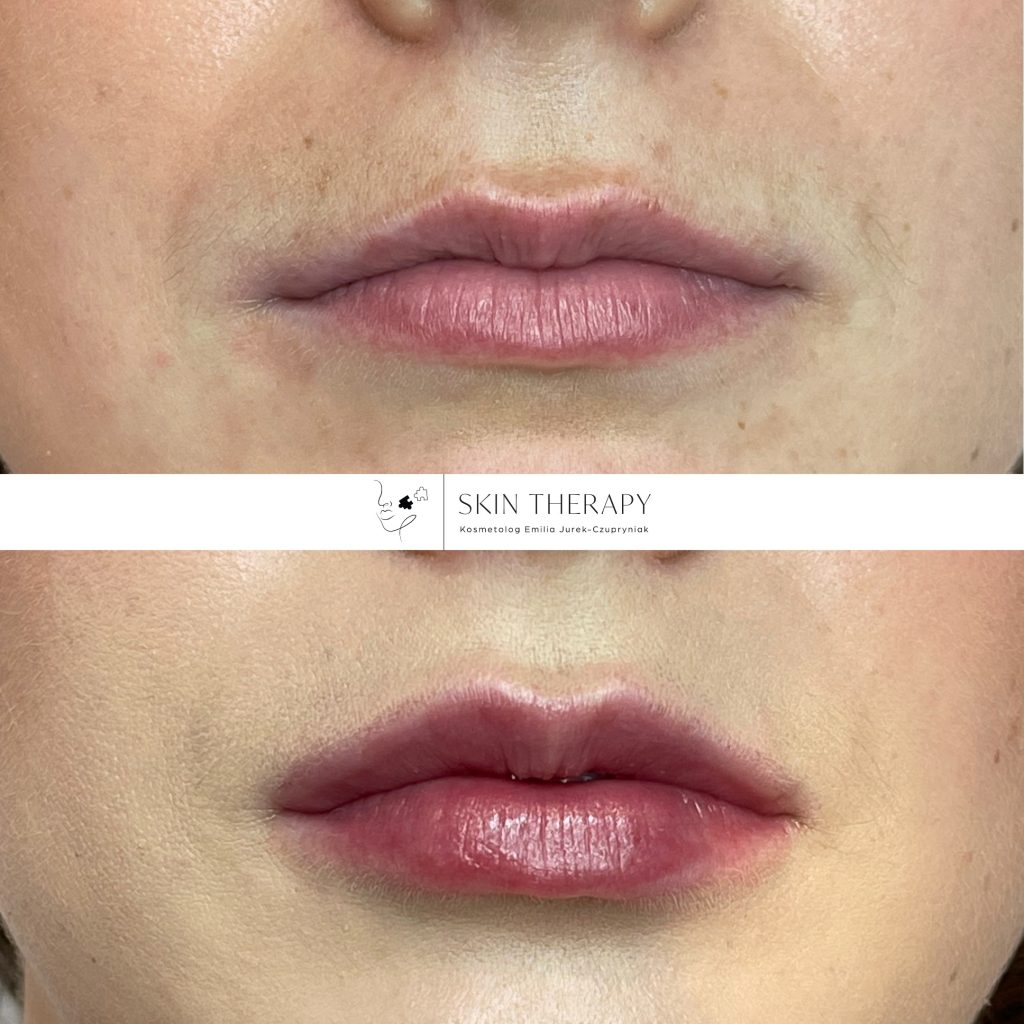 powiększanie ust – 15