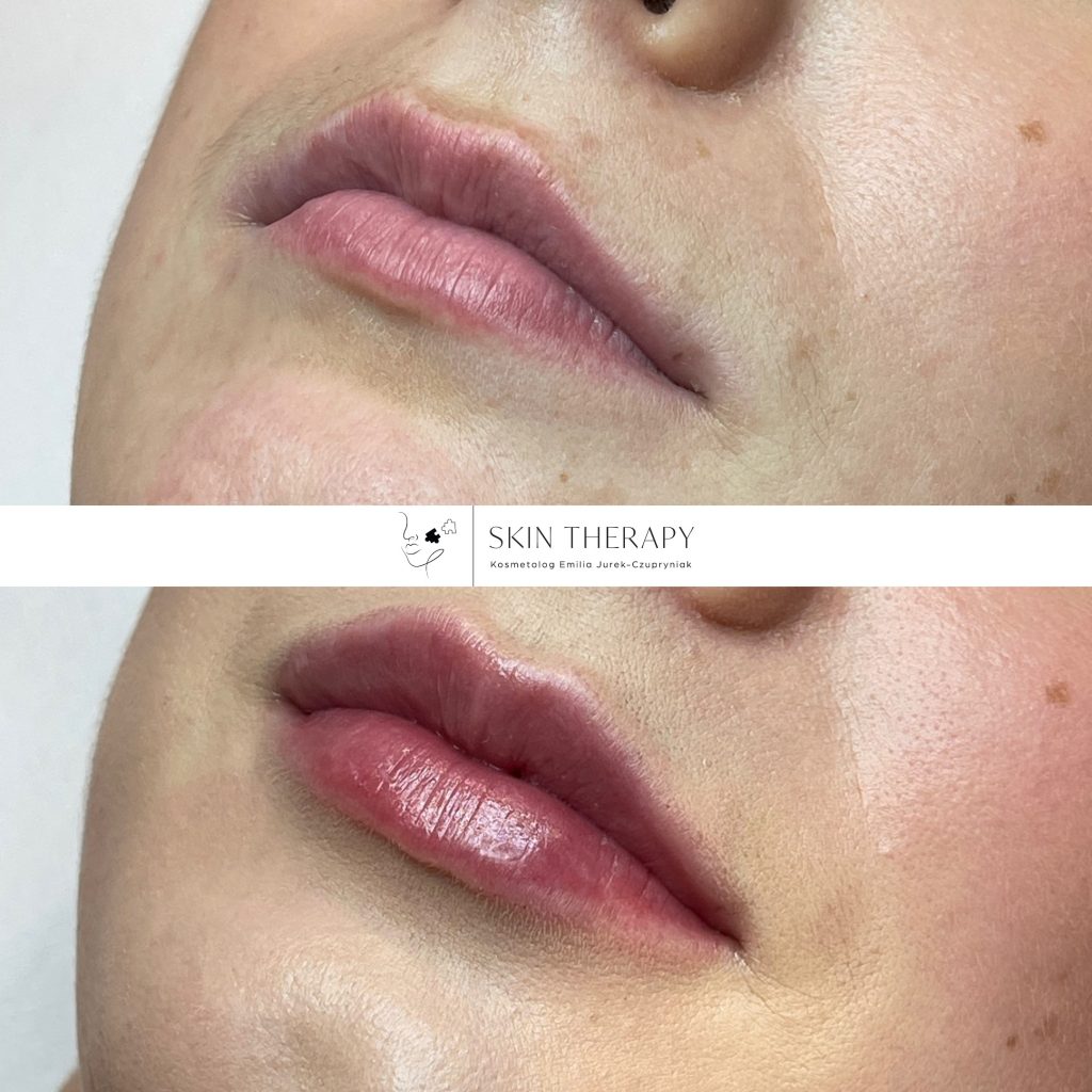 powiększanie ust – 12