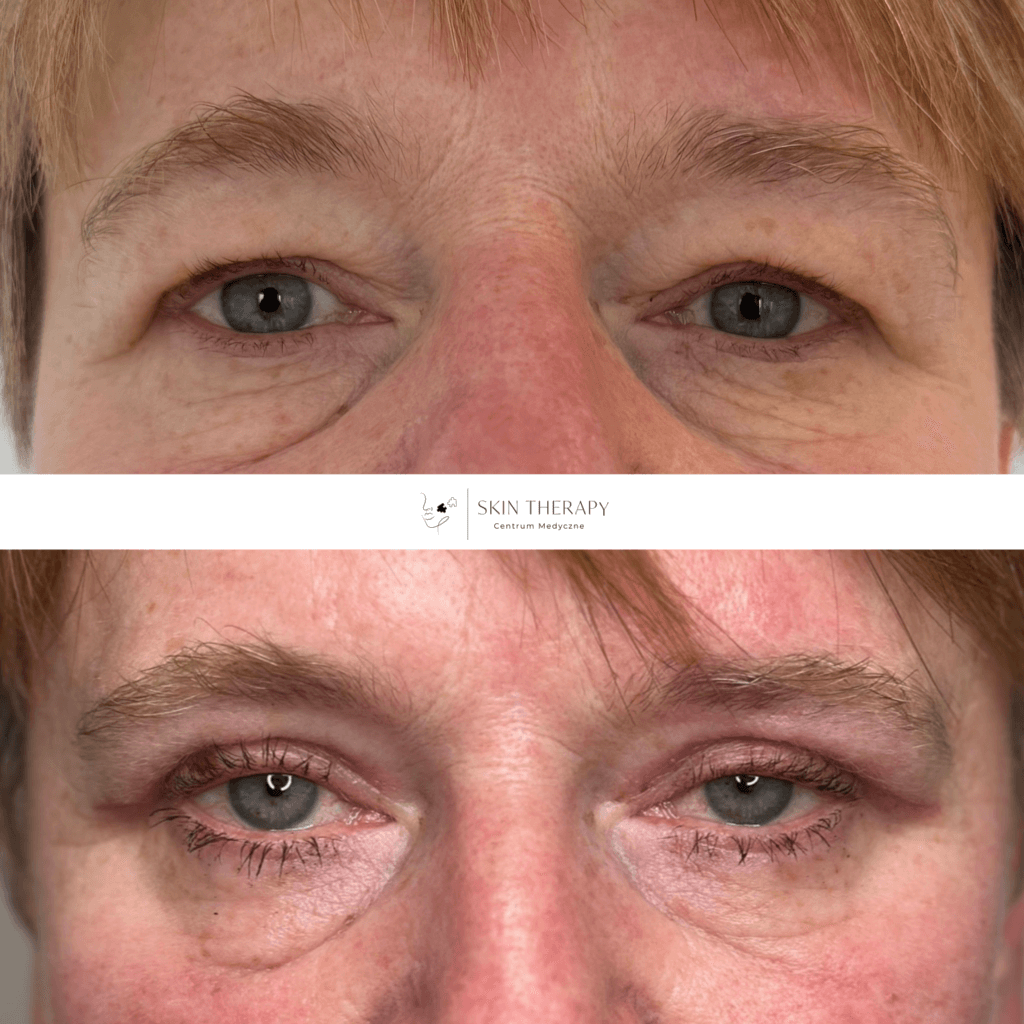 blefaroplastyka – 3