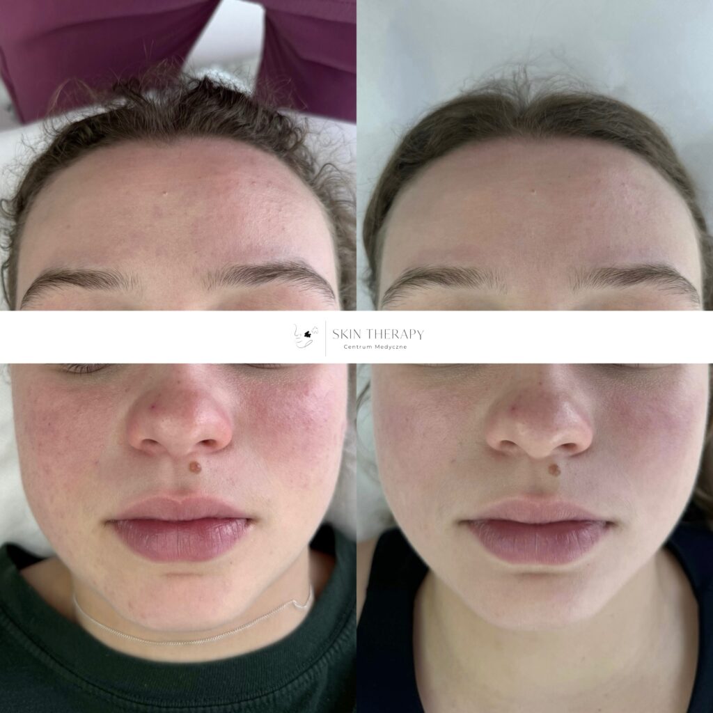 terapie skóry – 47