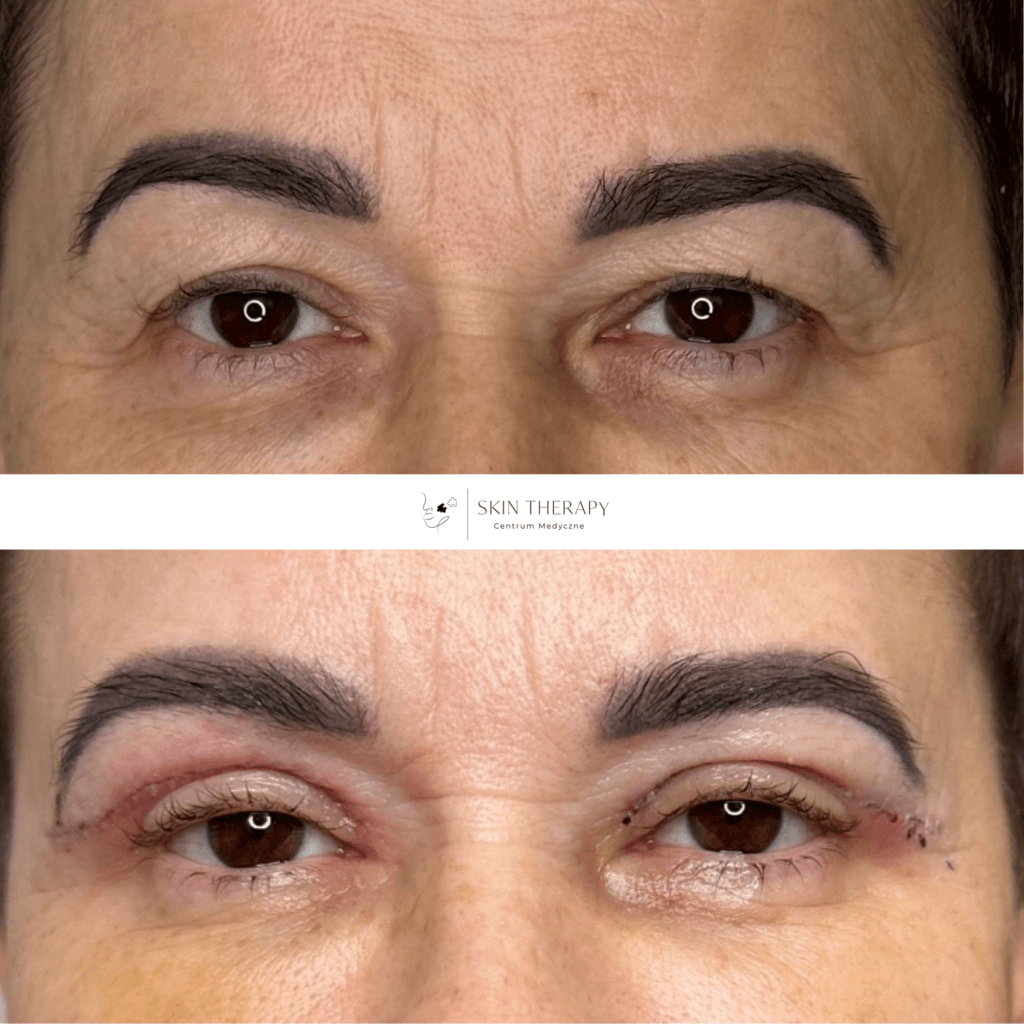 blefaroplastyka – 2