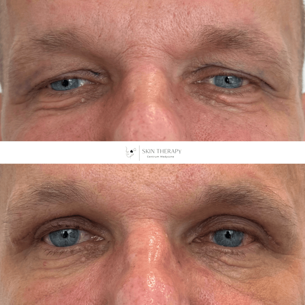 blefaroplastyka – 1