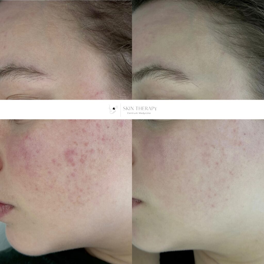 terapie skóry – 46
