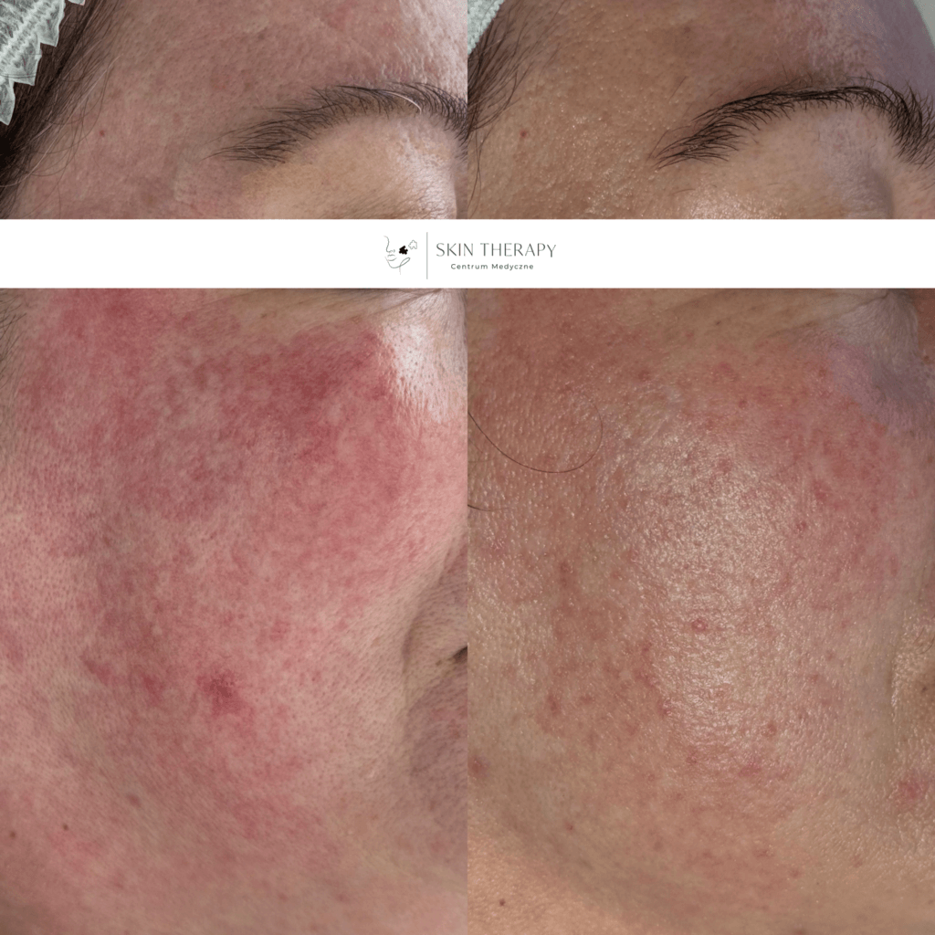 terapie skóry – 7