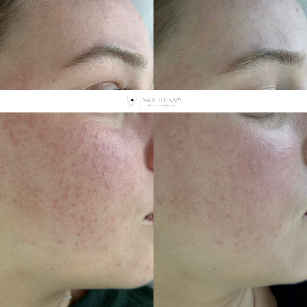 terapie skóry – 45