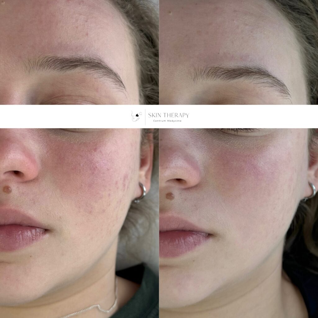 terapie skóry – 44