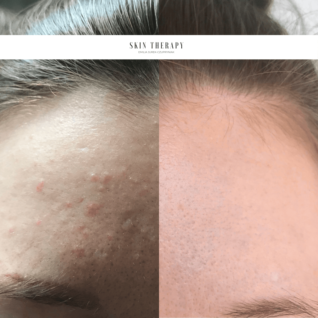 terapie skóry – 6