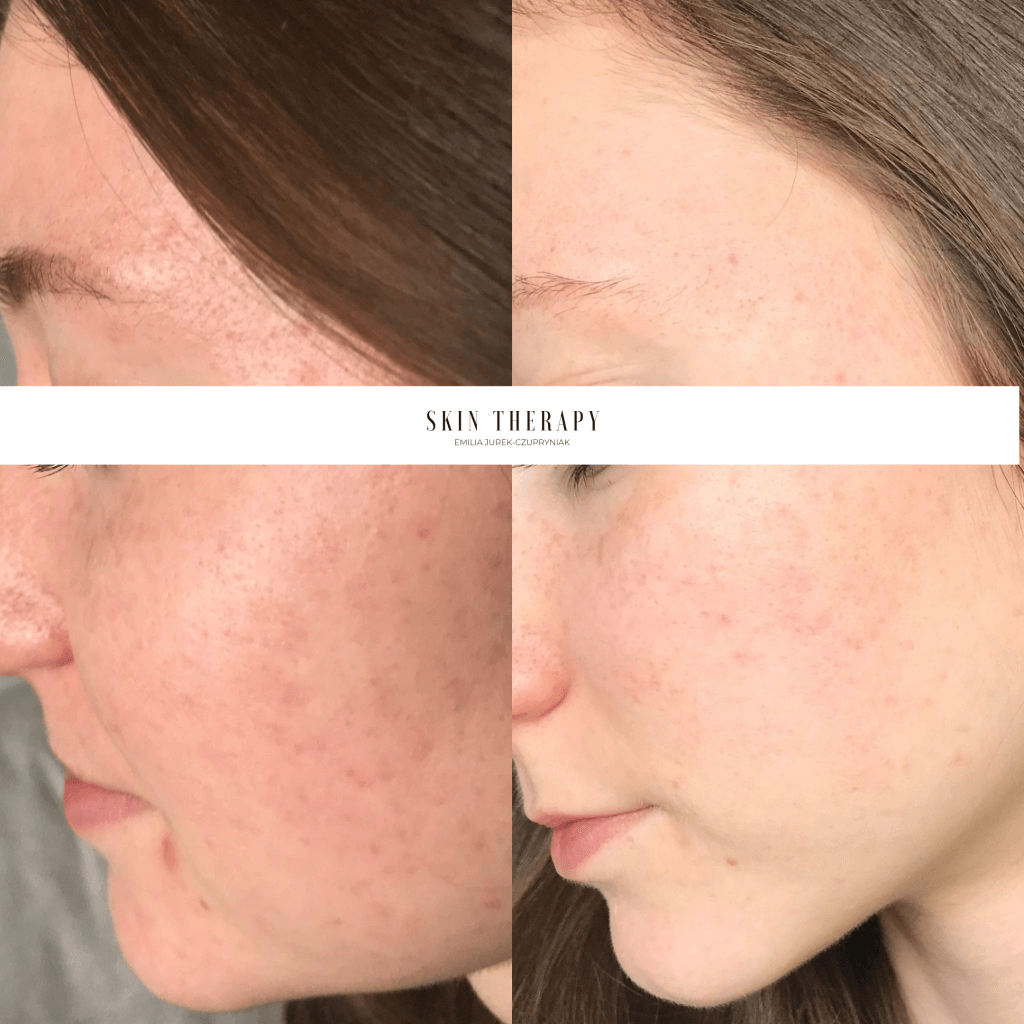terapie skóry – 20