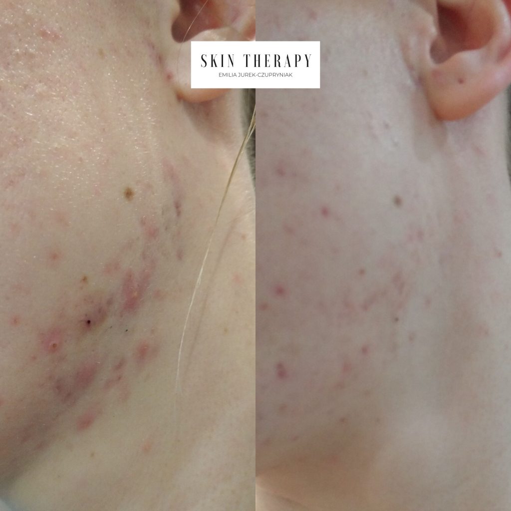 terapie skóry – 42
