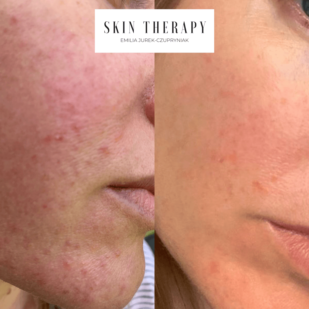 terapie skóry – 19