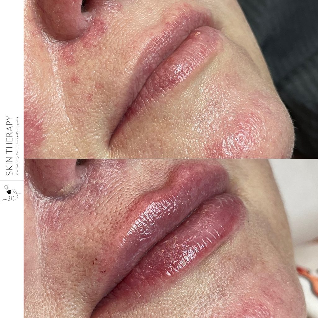 powiększanie ust – 6