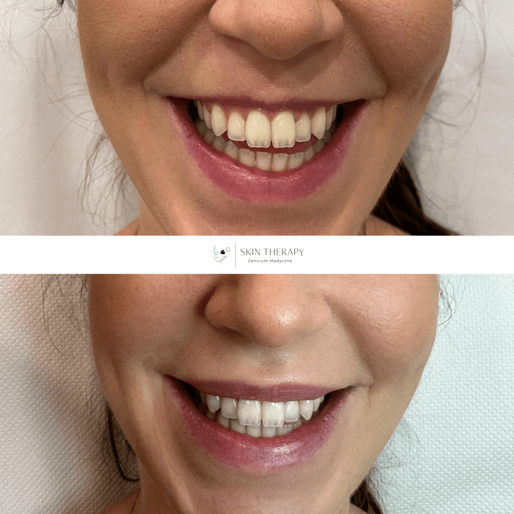 toksyna botulinowa – 1