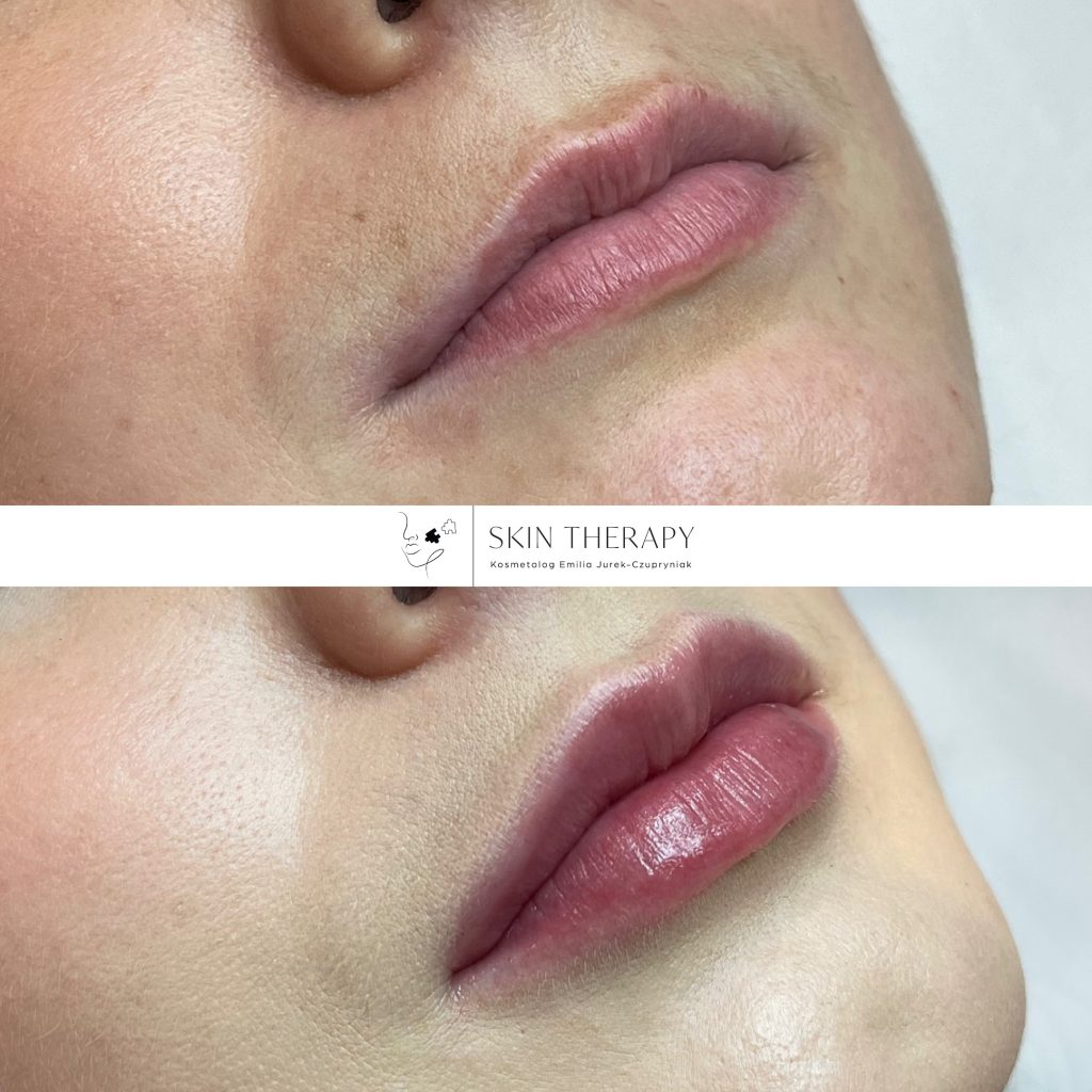 powiększanie ust – 13