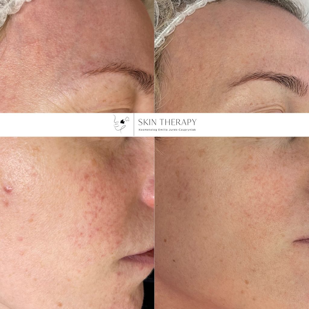 terapie skóry – 40