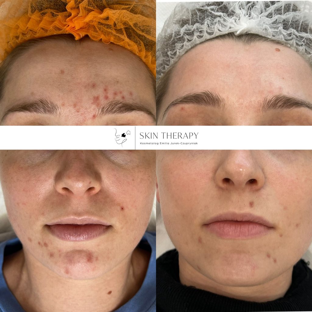 terapie skóry – 39