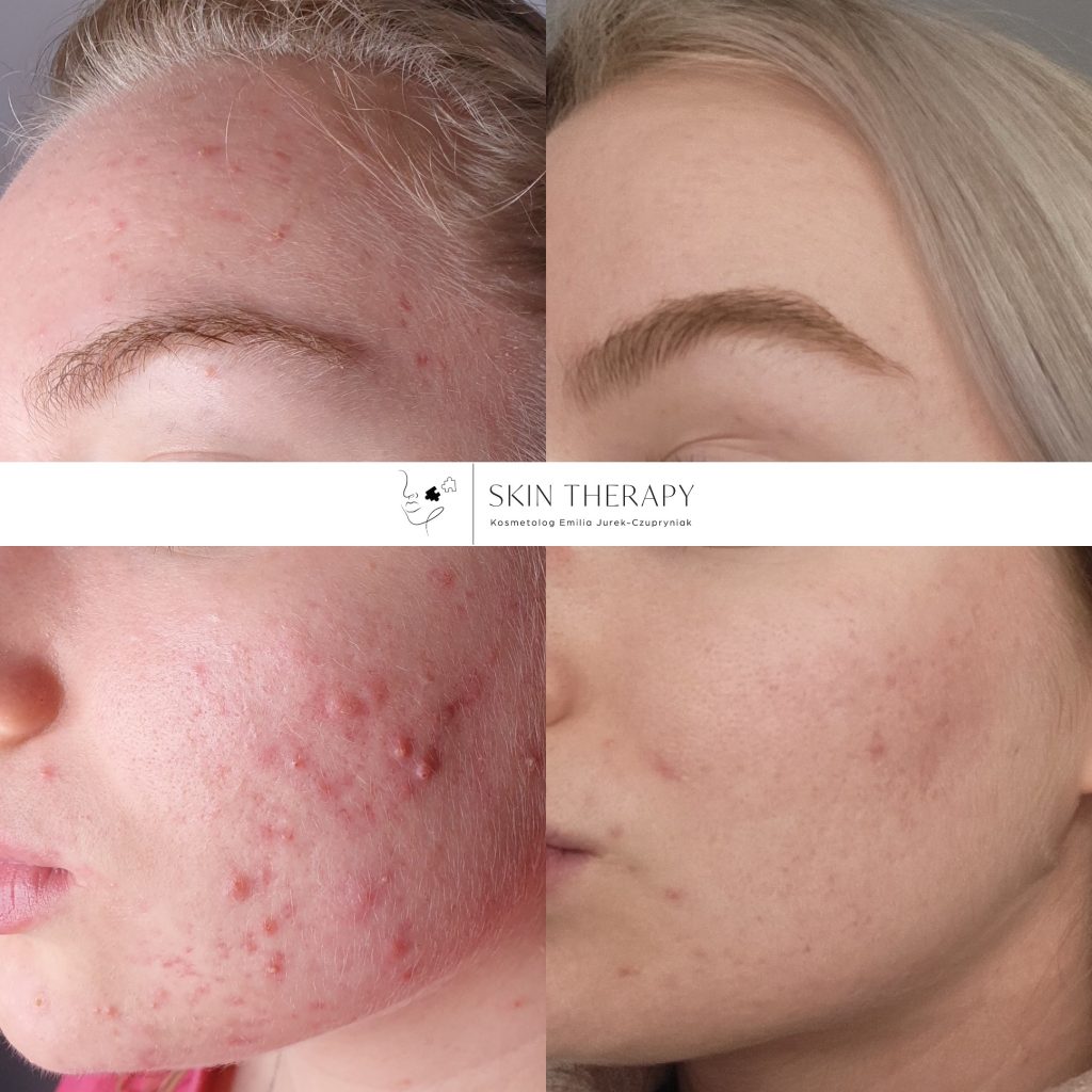 terapie skóry – 38