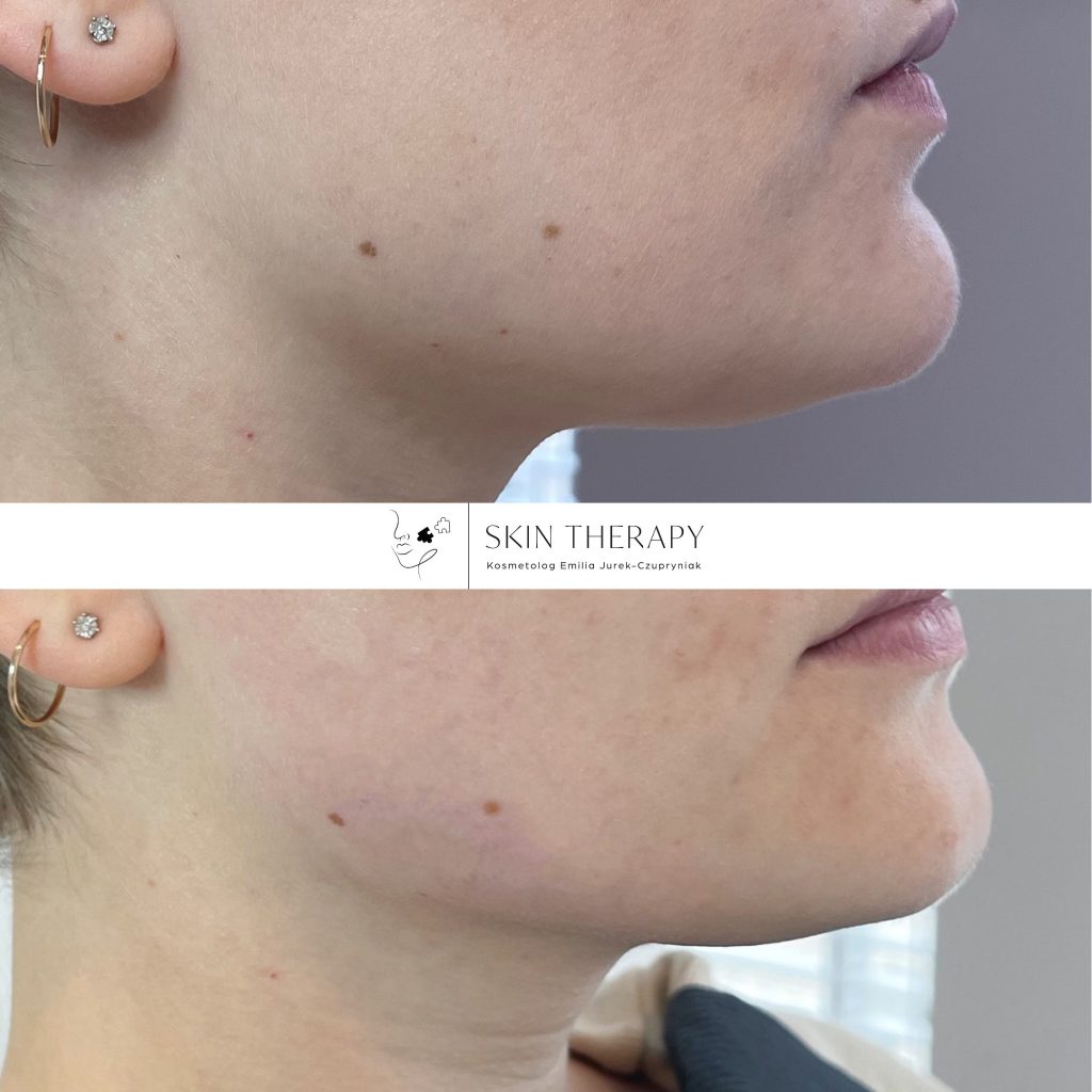 terapie skóry – 37