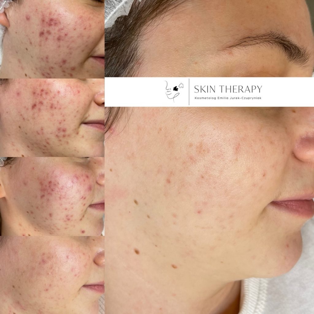 terapie skóry – 36