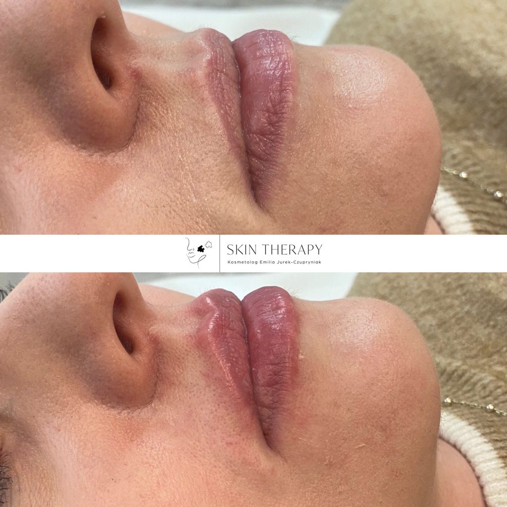 powiększanie ust – 10