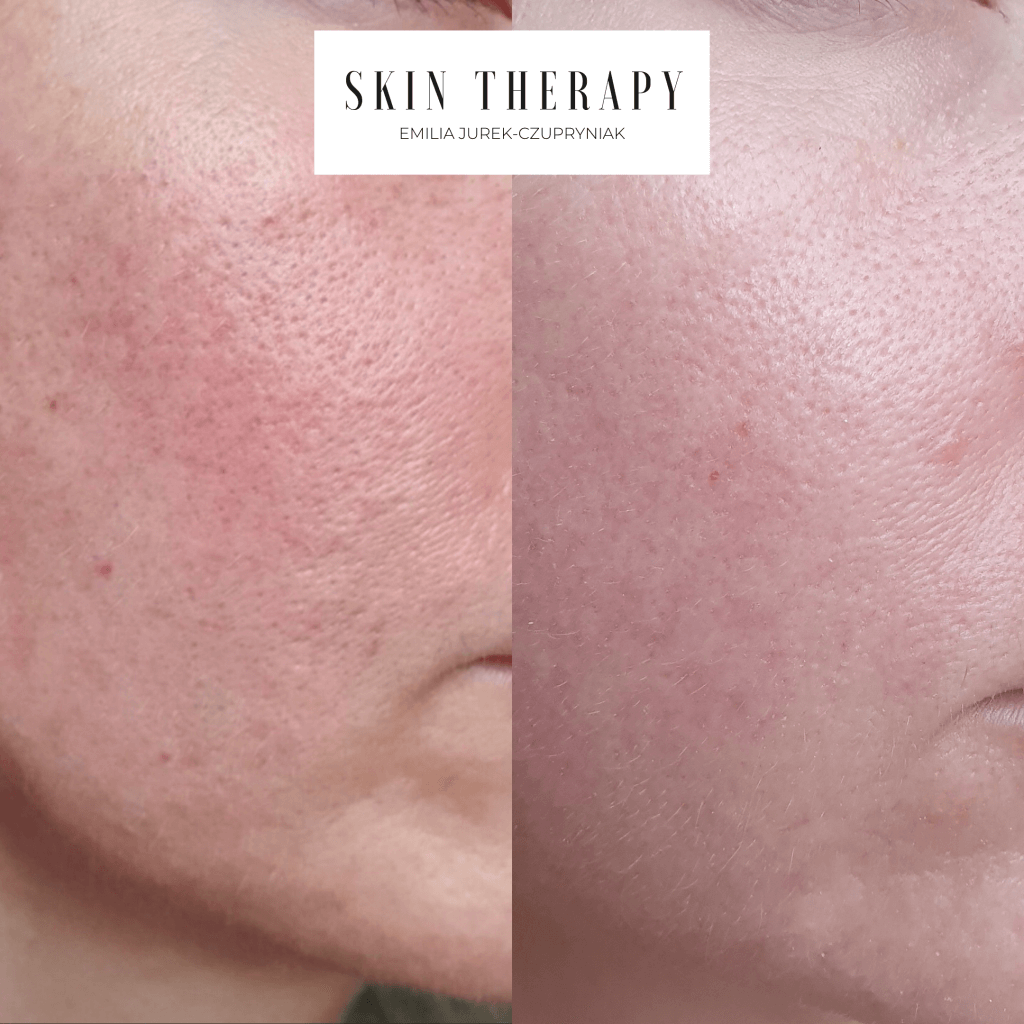 terapie skóry – 1