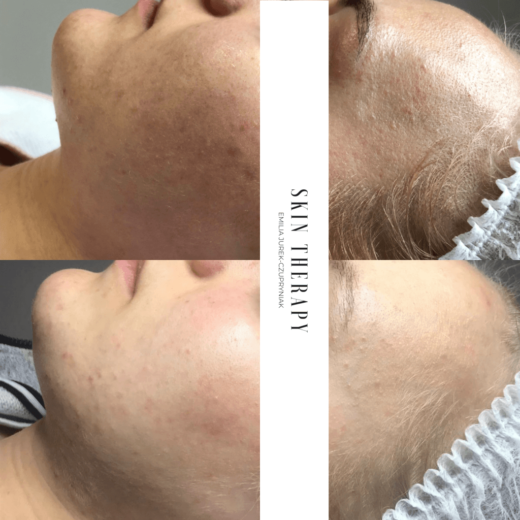 terapie skóry – 2