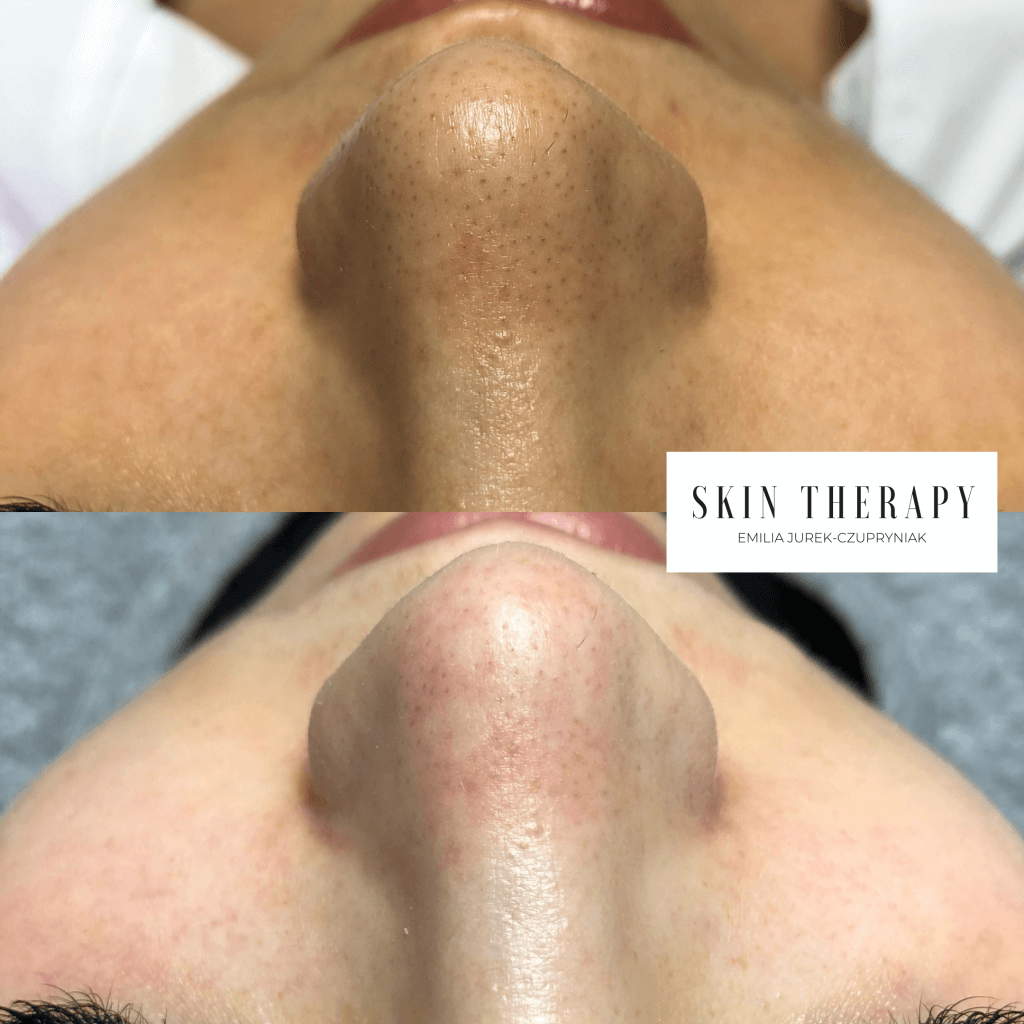 terapie skóry – 3