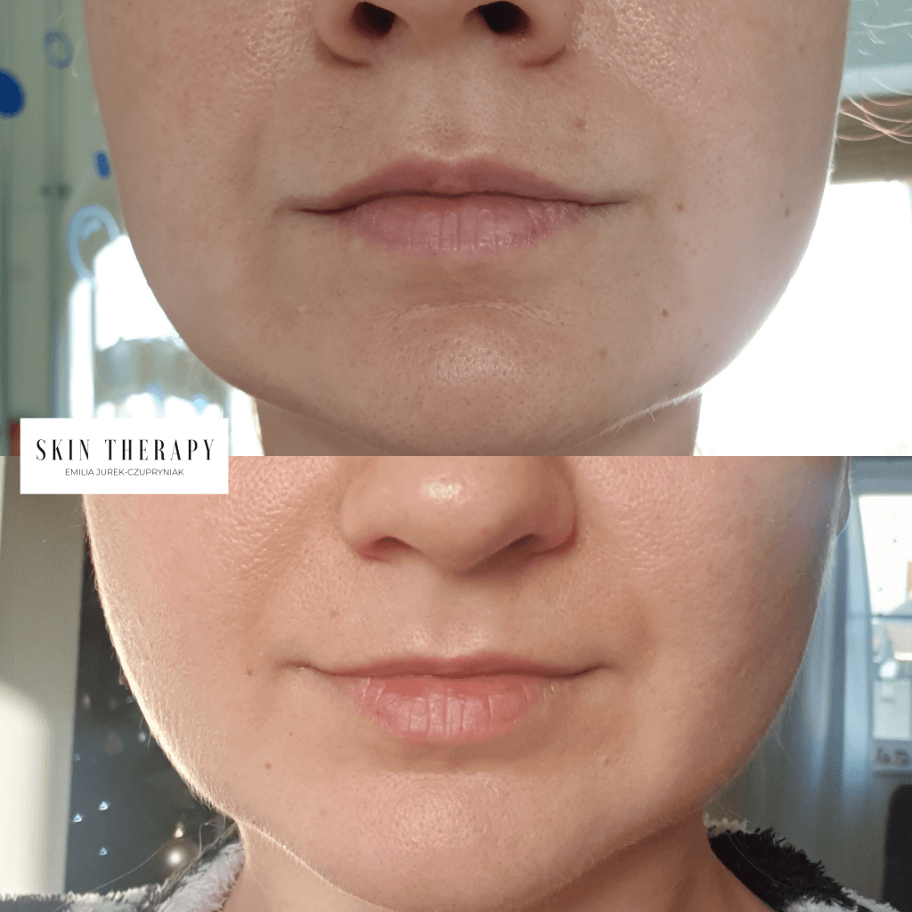 terapie skóry – 4